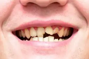 Cum să interpretezi un vis în care ai un dinte care se desprinde de pe gingii